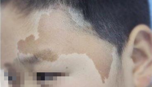 咖啡斑能自己消退吗