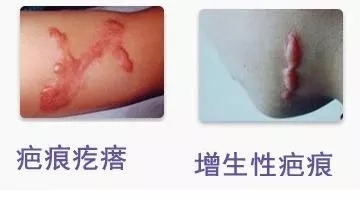 增生性疤痕和疤痕疙瘩