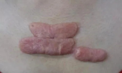 疤痕疙瘩生长